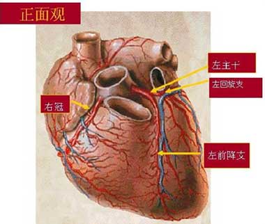 冠心病示意图