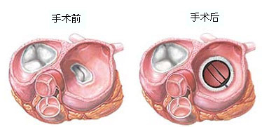 心脏瓣膜病手术示意图